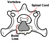 Bone Loss